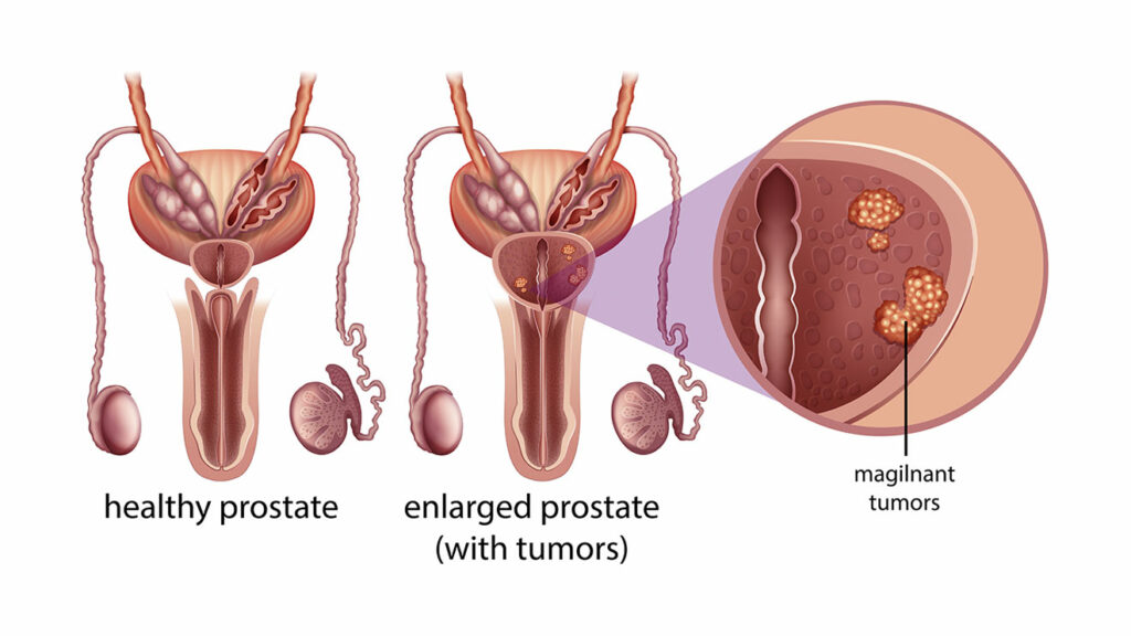 Prostate cancer tumor depiction