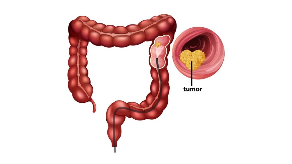 Colorectal cancer related to lynch syndrome