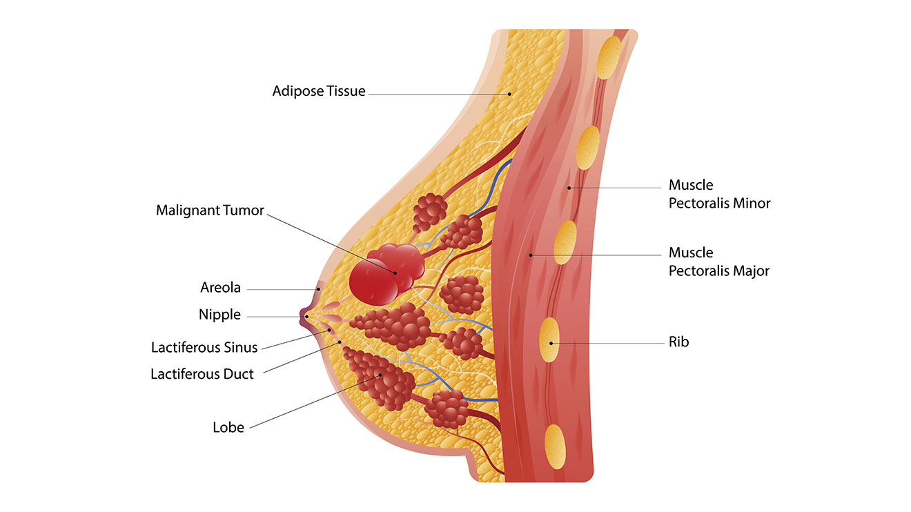Tumor formation in breast leading to breast cancer